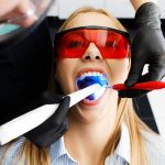 Diş Beyazlatma (Bleaching) Nedir? Nasıl Yapılır?